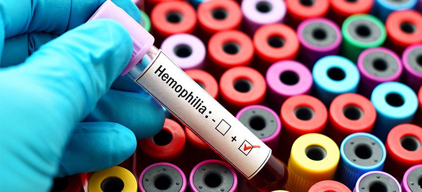 به مناسبت روز جهانی هموفیلی؛ همه آنچه باید درباره این بیماری بدانید!